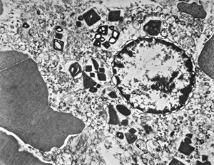 M,58y. | spleen - thesaurismosis of unknown origin … postmedicamentous? M,58y. | spleen - thesaurismosis of unknown origin … postmedicamentous?